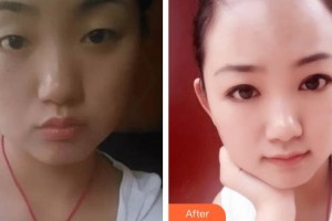 深圳?，斄猪槼毖劭漆t(yī)院卡夫恩整形價格表附眼部修復案例展示