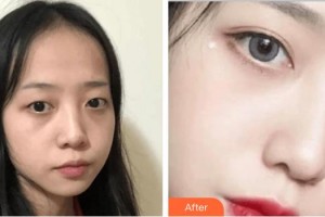 深圳?，斄猪槼毖劭漆t(yī)院哈斯爾整形價格表附切開雙眼皮案例展示