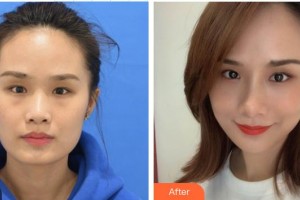 深圳希瑪林順潮眼科醫(yī)院萬竹整形價格表附激光去眼袋案例展示