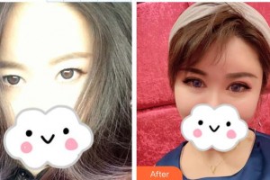 深圳希瑪林順潮眼科醫(yī)院劉泉整形價格表附眼部綜合案例展示