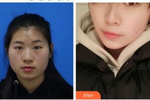 深圳希瑪林順潮眼科醫(yī)院黃俊華整形價格表附眼部綜合案例展示