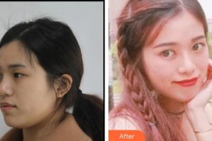 深圳?，斄猪槼毖劭漆t(yī)院尉洋整形價格表附眼部綜合案例展示