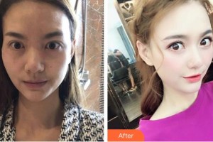 深圳?，斄猪槼毖劭漆t(yī)院袁野整形價格表附眼部修復案例展示