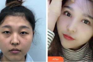 深圳?，斄猪槼毖劭漆t(yī)院林小銘整形價格表附眼部綜合案例展示