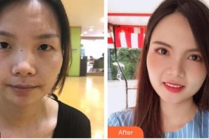 深圳?，斄猪槼毖劭漆t(yī)院舒敏整形價格表附切開雙眼皮案例展示