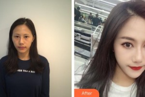 深圳?，斄猪槼毖劭漆t(yī)院石峰整形價格表附眼部修復案例展示