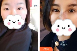 深圳?，斄猪槼毖劭漆t(yī)院范偉整形價格表附眼部綜合案例展示