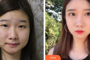 深圳希瑪林順潮眼科醫(yī)院林妙麗整形價格表附眼部整形雙眼皮案例展示