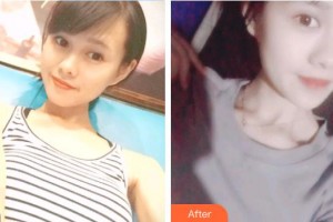 深圳?，斄猪槼毖劭漆t(yī)院江英整形價格表附開內(nèi)眼角案例展示