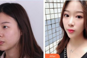 深圳華夏眼科醫(yī)院姚穎整形價格表附雙眼皮案例展示