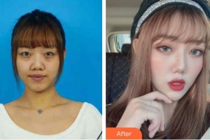 深圳華夏眼科醫(yī)院王建輝整形價格表附內(nèi)切祛眼袋案例展示