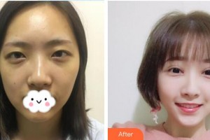 深圳杏雙醫(yī)療美容醫(yī)院姚歐整形價(jià)格表附眼部綜合案例展示