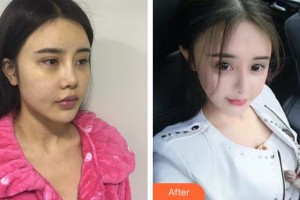 懷化市第一人民醫(yī)院張繼揚(yáng)整形價(jià)格表附鼻部綜合案例展示