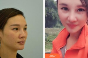 懷化市第一人民醫(yī)院易斌整形價(jià)格表附鼻部綜合案例展示