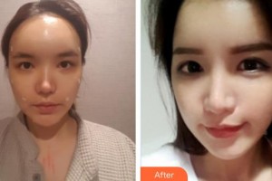 懷化市第一人民醫(yī)院于蘭整形價(jià)格表附鼻部綜合案例展示