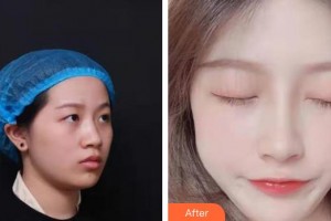 東莞百佳瑪麗亞婦產(chǎn)醫(yī)院金哉勛整形價格表附鼻部綜合案例展示