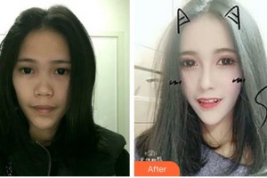 東莞美極醫(yī)療美容門診部鄭友玲整形價(jià)格表附肋軟骨隆鼻案例展示