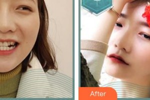 東莞同濟(jì)光華醫(yī)院口腔科龍亞香整形價(jià)格表附隱形托槽矯正案例展示