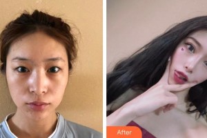 東莞華廈眼科醫(yī)院袁進(jìn)整形價格表附眼部綜合案例展示