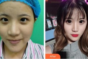 東莞愛爾眼科醫(yī)院扶城賓整形價格表附切開雙眼皮案例展示