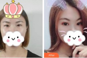 東莞華廈眼科醫(yī)院趙聰梅整形價格表附眼部綜合案例展示