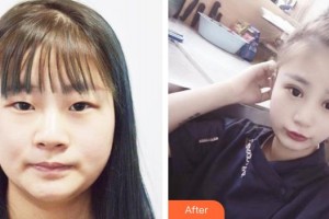 東莞光明眼科醫(yī)院陳家祺整形價格表附眼部整形雙眼皮案例展示