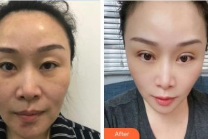 東莞光明眼科醫(yī)院黃圣鄧整形價格表附內(nèi)切祛眼袋案例展示