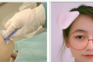 東莞南城固德口腔門診部何繼帥整形價格表附隱形托槽矯正案例展示