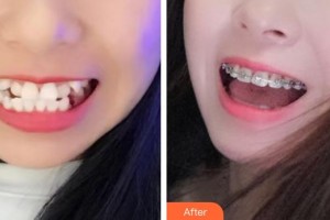 東莞拜爾口腔門診部李銳景整形價(jià)格表附牙齒隱形矯正案例展示