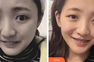 東莞拜爾口腔門診部林金昆整形價(jià)格表附牙齒隱形矯正案例展示