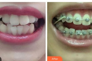 東莞臺(tái)心醫(yī)院口腔科曾思整形價(jià)格表附金屬托槽矯正案例展示