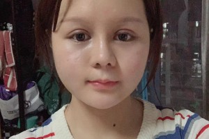 上海時(shí)光整形外科醫(yī)院李靜林醫(yī)生顴骨手術(shù)果太好了