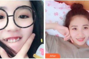 景德鎮(zhèn)圣嘉麗醫(yī)療美容門診部劉志強整形價格表附牙齒隱形矯正案例展示