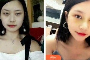 景德鎮(zhèn)圣嘉麗醫(yī)療美容門診部李俊偉整形價格表附埋線雙眼皮案例展示