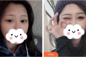 景德鎮(zhèn)市第一人民醫(yī)院美容整形外科何平整形價格表附眼部綜合案例展示