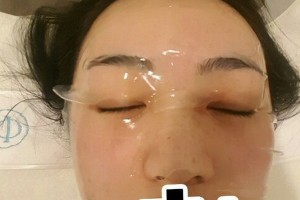 廣州南方醫(yī)院美容科熱瑪吉果好不好附日記分享