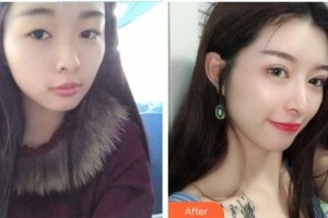 慈溪圣愛醫(yī)院整形美容科鄭聰聰整形價(jià)格表附鼻部綜合案例展示