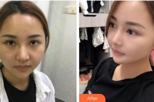 慈溪圣愛醫(yī)院整形美容科陶衛(wèi)整形價(jià)格表附鼻部綜合案例展示