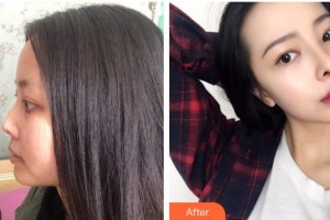 慈溪悅爾醫(yī)學(xué)美容醫(yī)院展望整形價(jià)格表附鼻部綜合案例展示