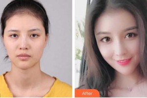 慈溪悅爾醫(yī)學(xué)美容醫(yī)院張庸柱整形價(jià)格表附鼻部綜合案例展示