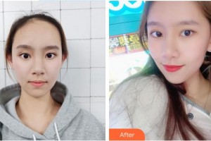 慈溪悅爾醫(yī)學(xué)美容醫(yī)院卜雙燕整形價(jià)格表附鼻部綜合案例展示