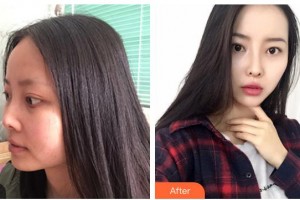 慈溪悅爾醫(yī)學(xué)美容醫(yī)院賈晶整形價(jià)格表附鼻部綜合案例展示