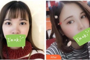 慈溪悅爾醫(yī)學(xué)美容醫(yī)院趙天宇整形價(jià)格表附鼻部綜合案例展示