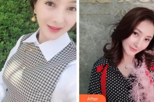 慈溪陽明醫(yī)療美容門診部黃雪麗整形價(jià)格表附鼻部綜合案例展示