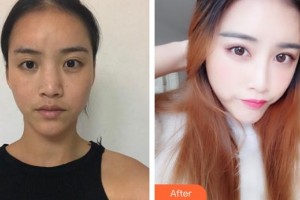 慈溪悅爾醫(yī)學(xué)美容醫(yī)院吳仁欽整形價(jià)格表附肋軟骨隆鼻案例展示