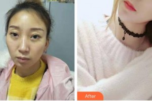 慈溪悅爾醫(yī)學(xué)美容醫(yī)院林振東整形價(jià)格表附鼻部綜合案例展示