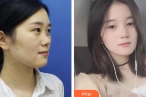 慈溪圣愛醫(yī)院整形美容科王志忠整形價(jià)格表附鼻部綜合案例展示