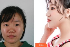 東陽吳少珍醫(yī)學(xué)美容診所吳少珍整形價(jià)格表附耳軟骨復(fù)合隆鼻案例展示