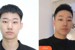 東陽麗萊醫(yī)療美容醫(yī)院鄧飛艷整形價(jià)格表附鼻部綜合案例展示