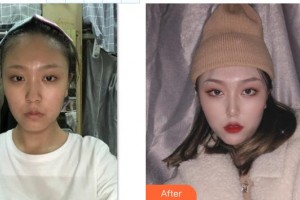 東陽麗萊醫(yī)療美容醫(yī)院顏正安整形價(jià)格表附鼻部綜合案例展示